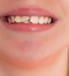 חבלה בשיניים קדמיות - תמונת המחשה